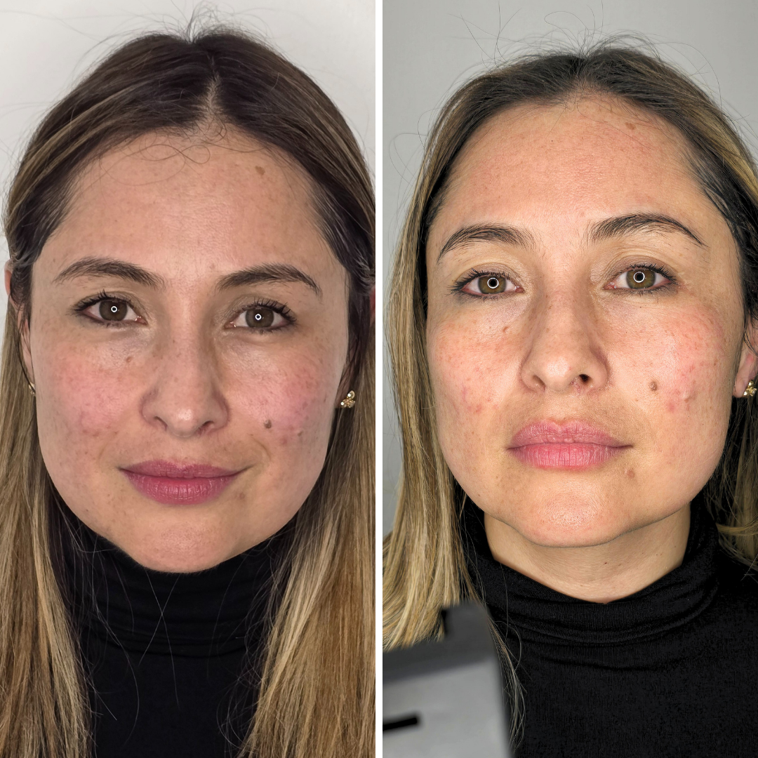 Hydrafacial Cleaning (6)