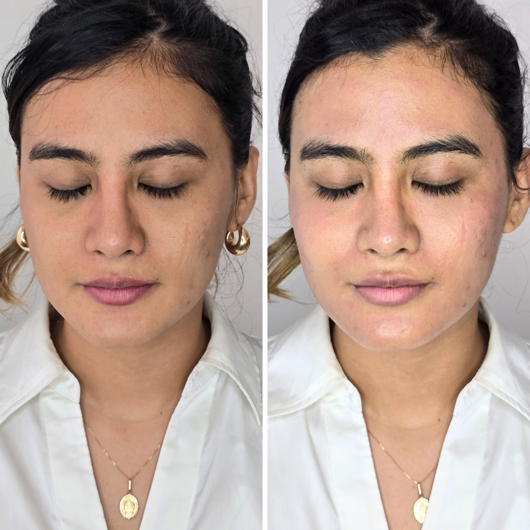 Hydrafacial Cleaning (7)