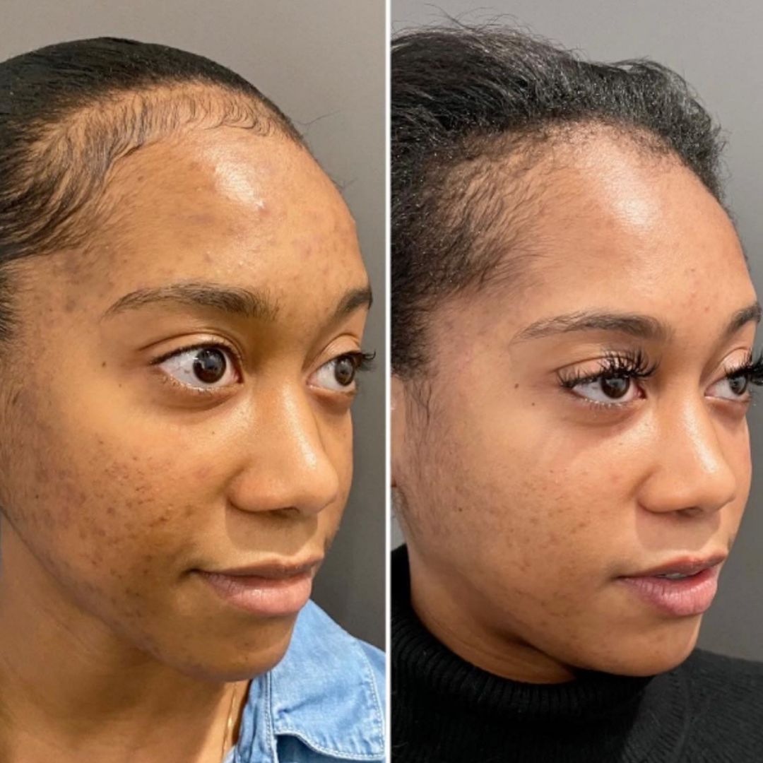 Peeling Facial Tratamiento (6)