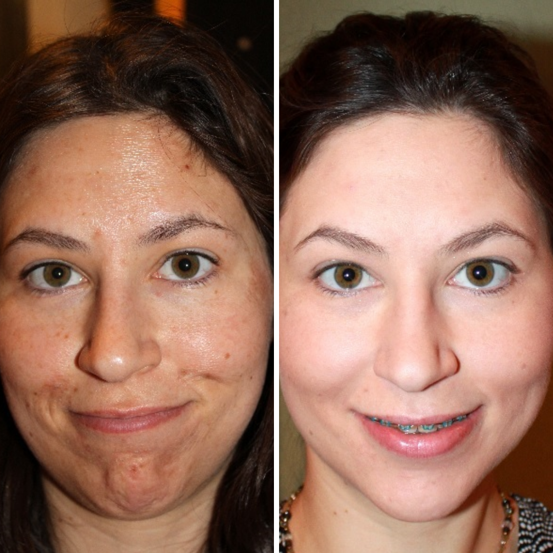 Peeling Facial Tratamiento (7)