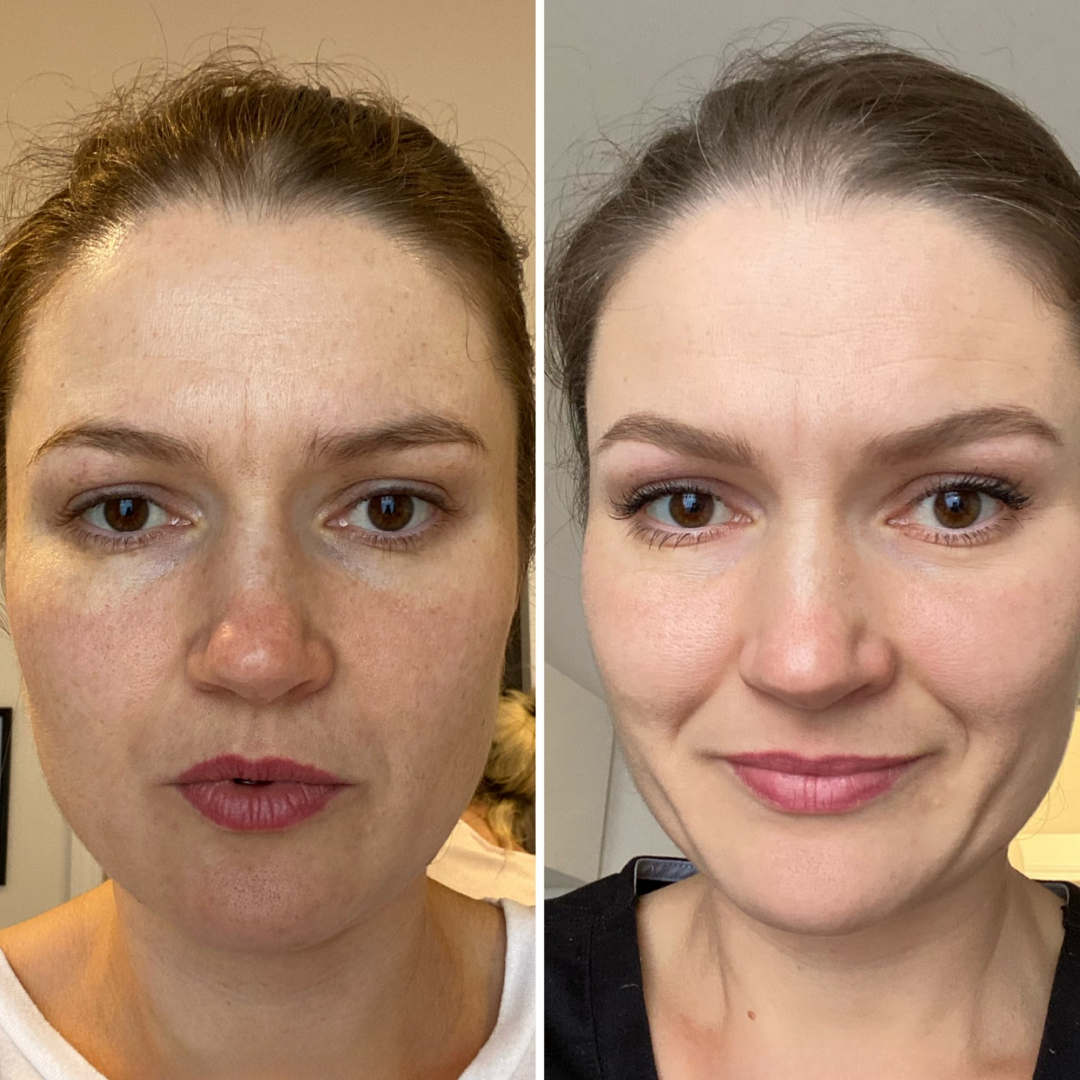 Peeling Facial Tratamiento (8)