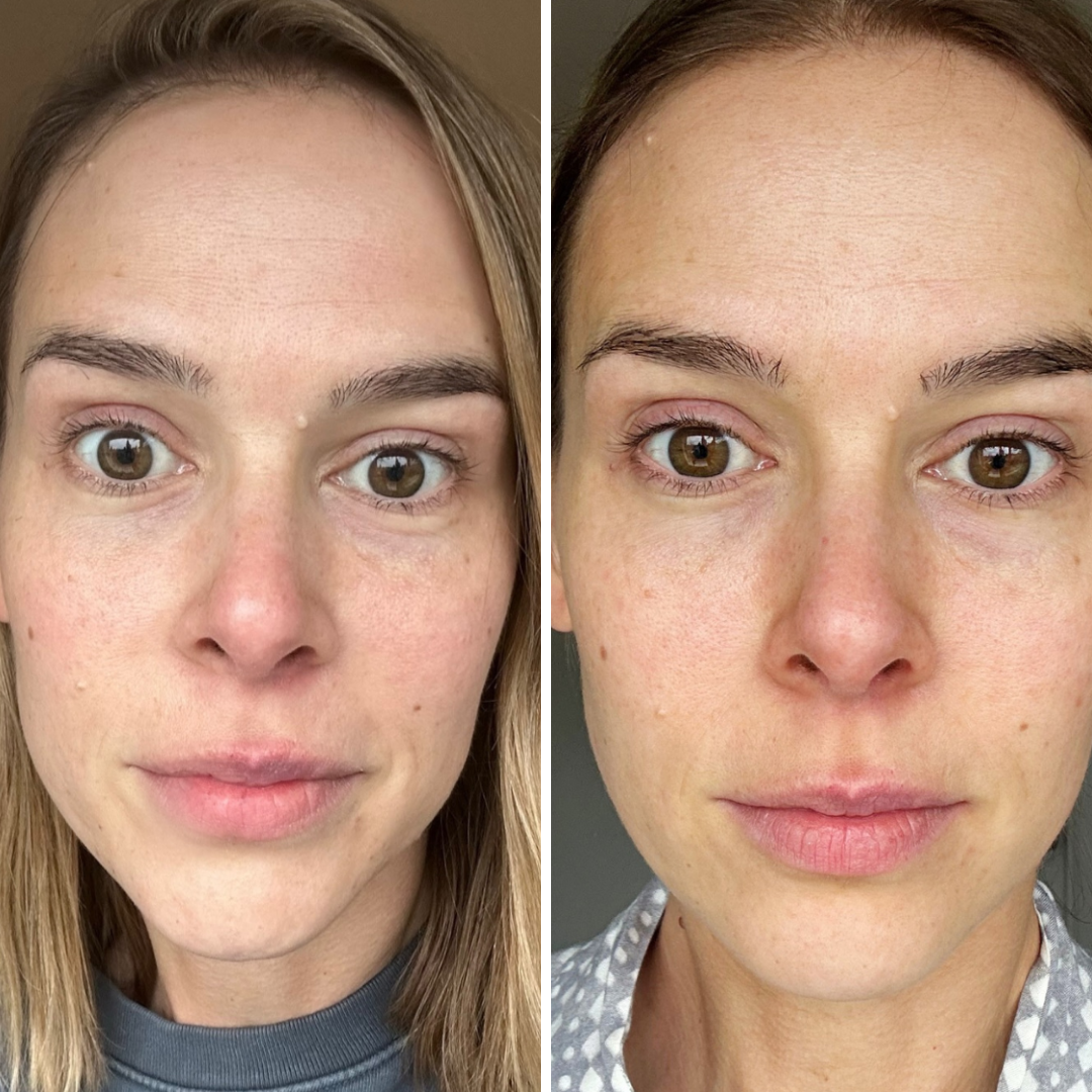 Plasma Rico en Plaquetas Facial Tto (6)