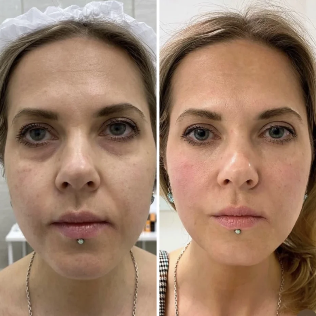 Plasma Rico en Plaquetas Facial Tto (7)