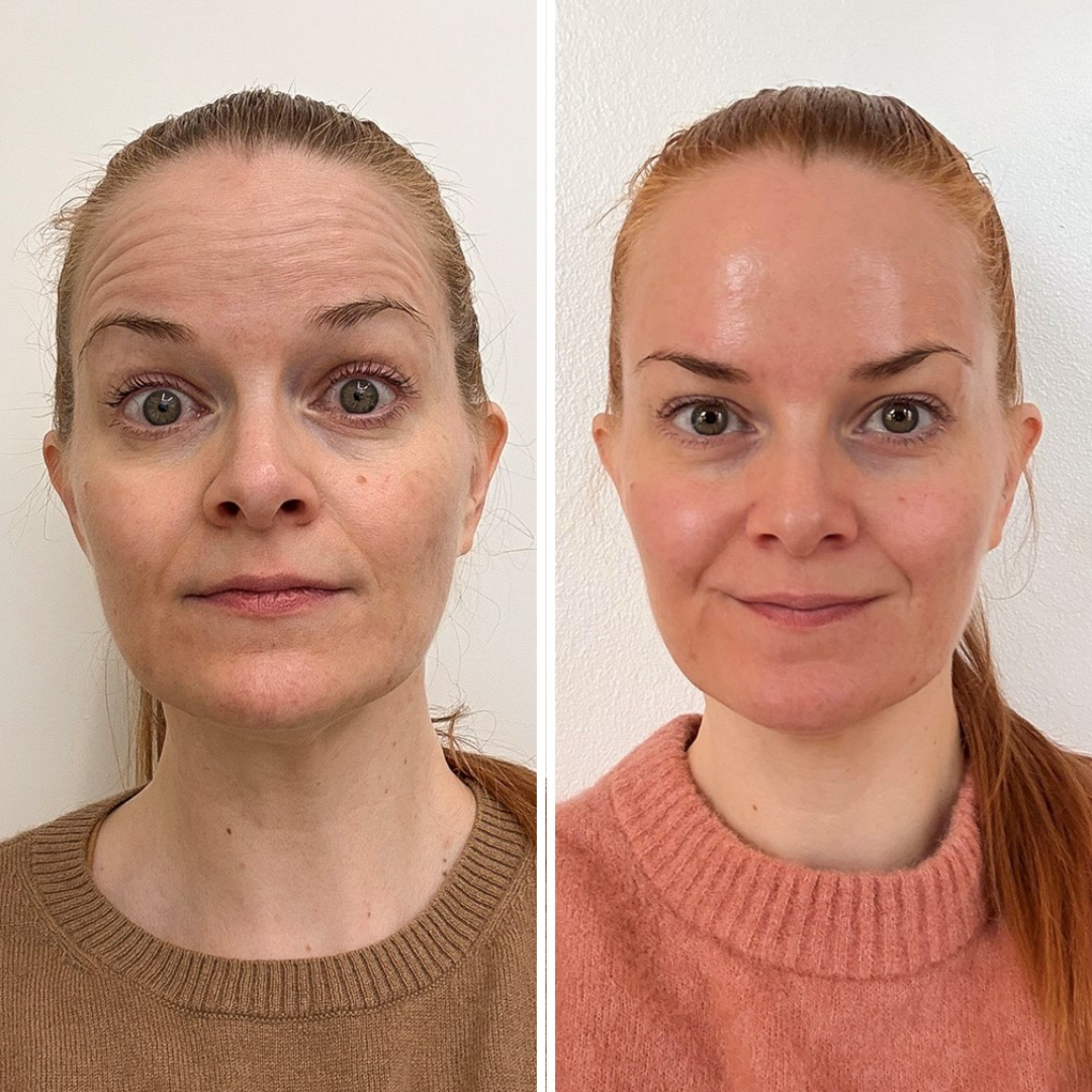 Toxina Botulínica (1)