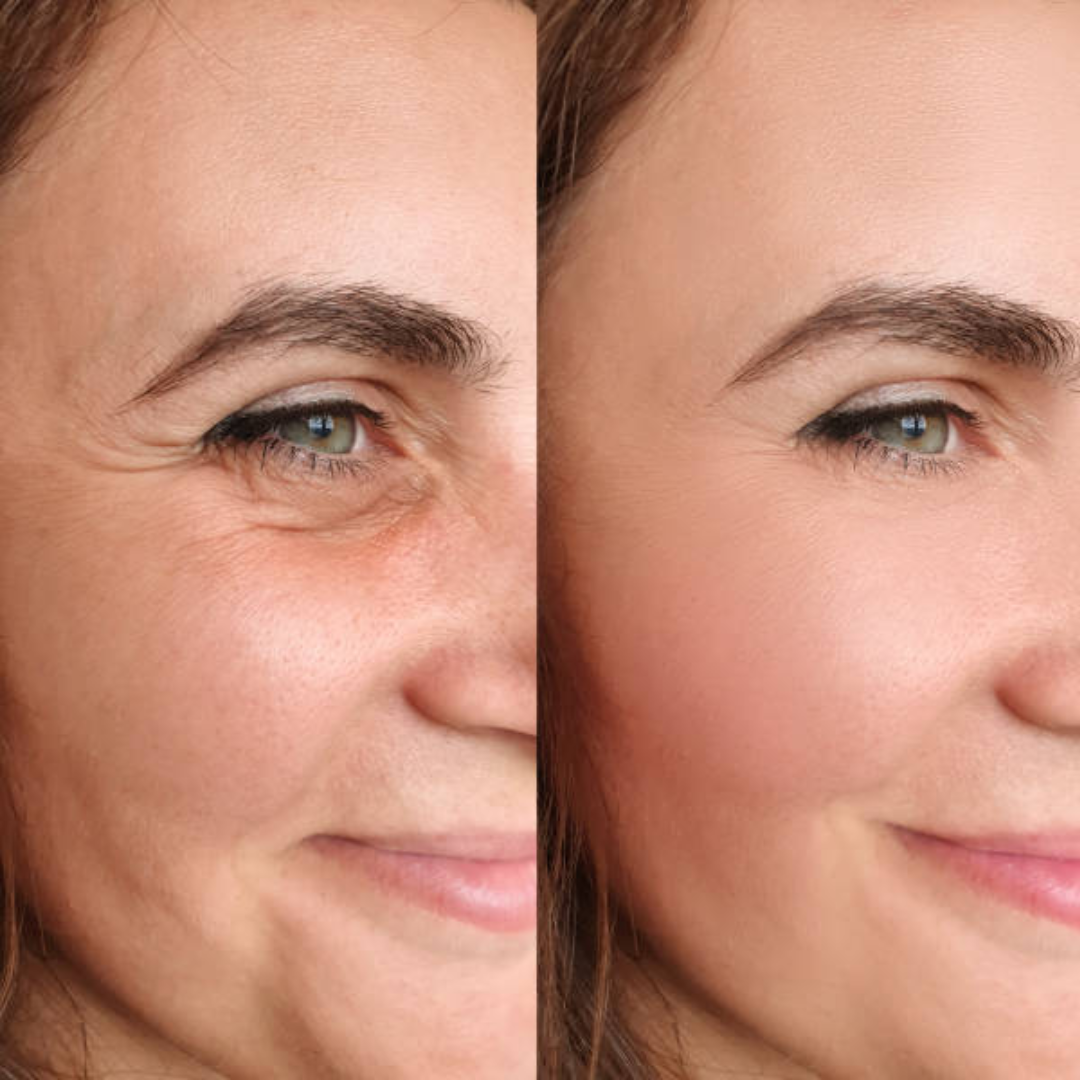 Toxina Botulínica (2)