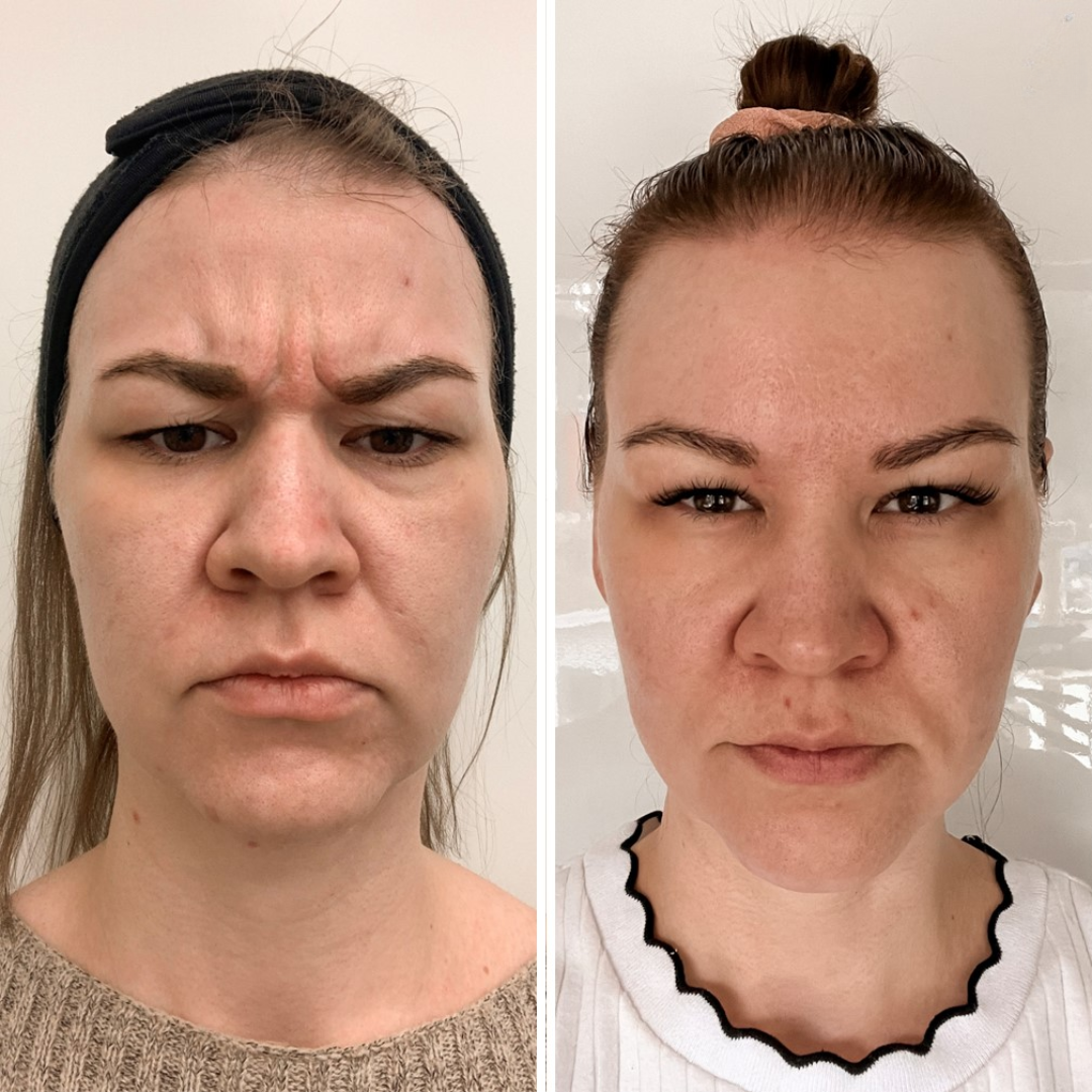 Toxina Botulínica (3)