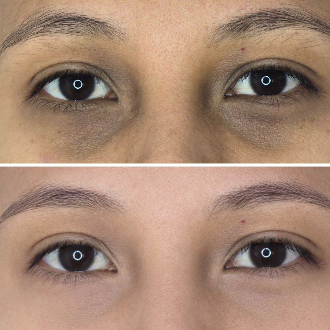 Tratamiento Ojeras (6)