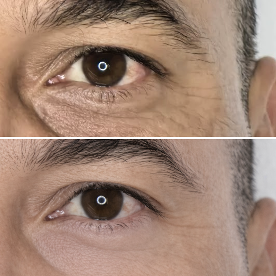 Tratamiento Ojeras (7)