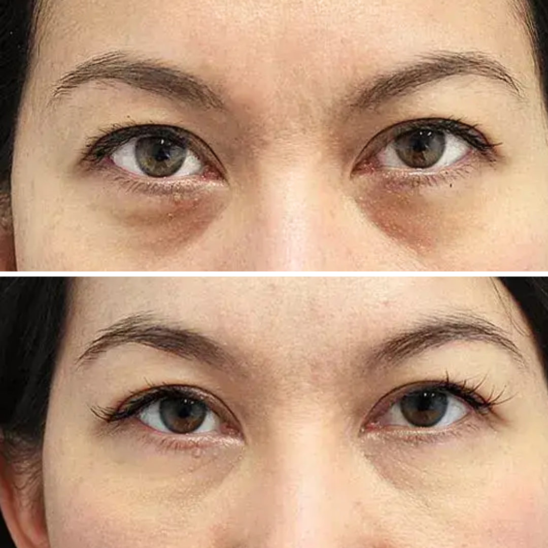 Tratamiento Ojeras (8)