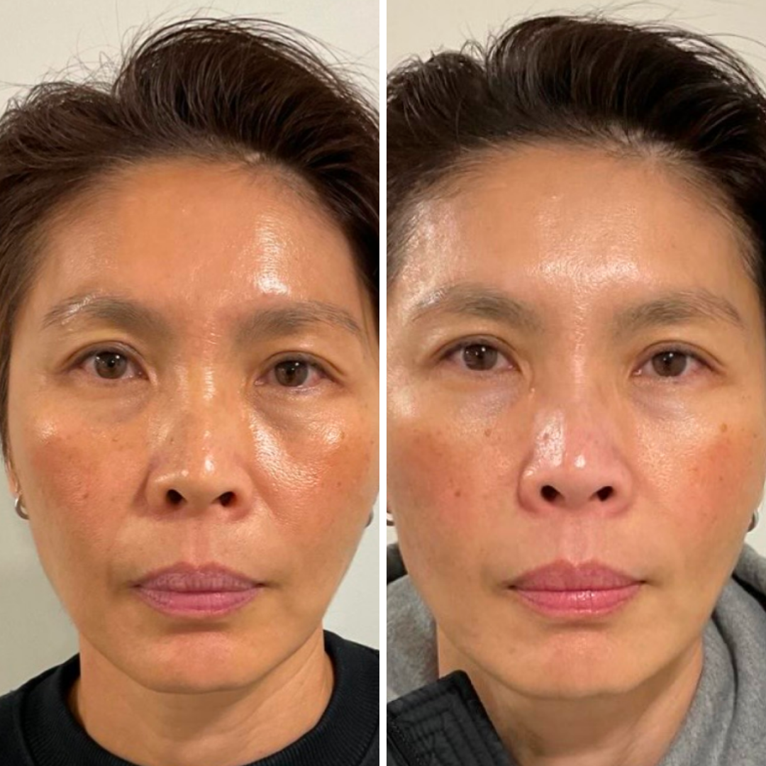 polinucleotidos tratamiento (7)