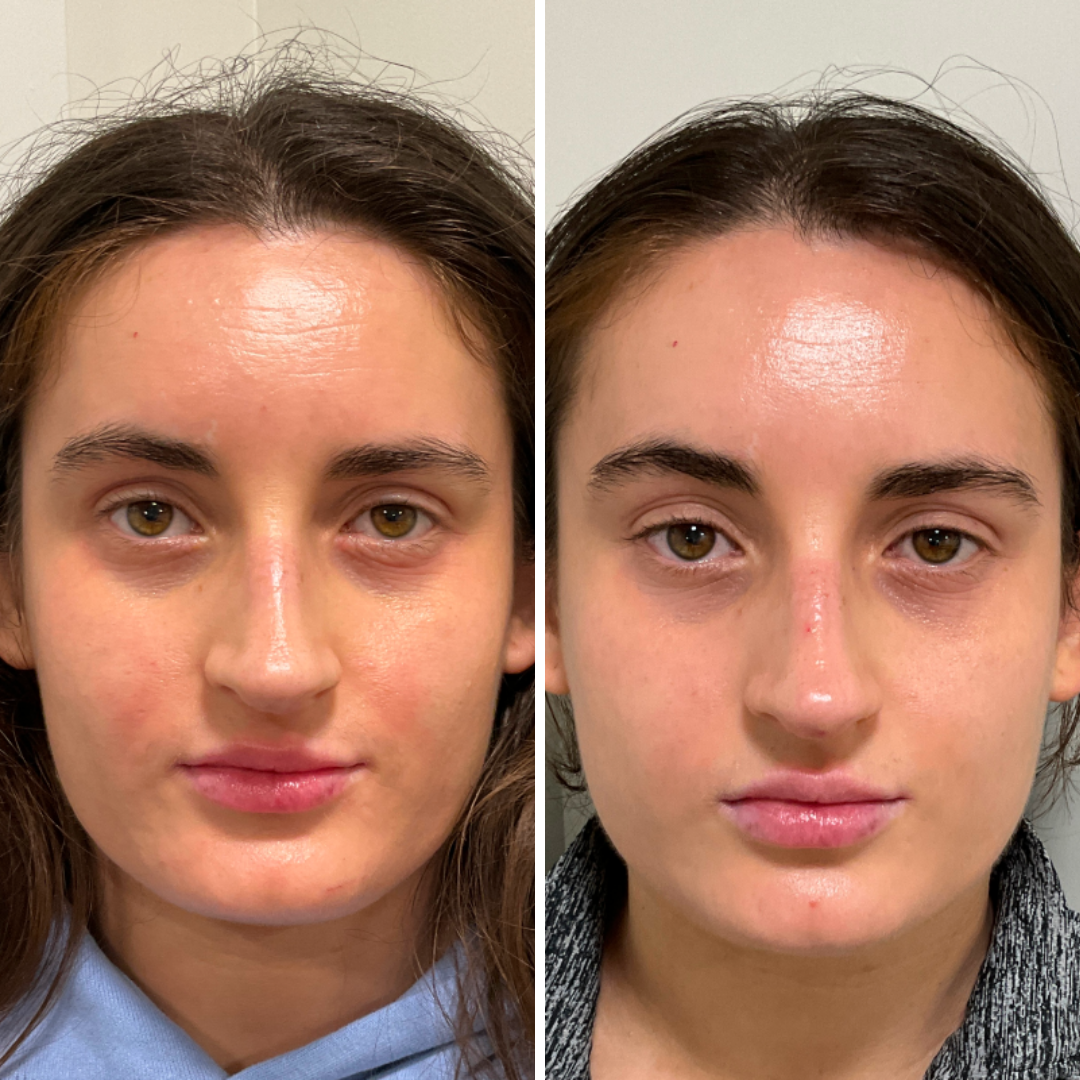 polinucleotidos tratamiento (9)